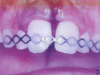 Splint Incert D435L09 Dental Trauma%2C Cracked teeth %26 Root Fracture.ppt