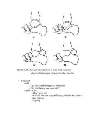 Hình 1. Phân loại gãy cổ xương sên theo Hawkins
5- Chẩn đoán
Loại I :
- Dựa vào cơ chế làm nghi gãy xƣơng sên
- Chủ yếu Xquang (đọc quan sát kỹ)
Loại II, III, IV
- Dựa vào cơ chế
- Các dấu hiệu lâm sàng : biến dạng điển hình ở cổ chân và
ngón chân cái
- Xquang
 