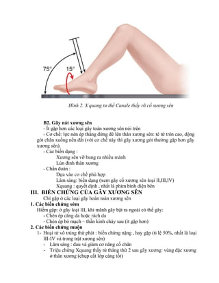 Hình 2. X quang tư thế Canale thấy rõ cổ xương sên
B2. Gãy nát xƣơng sên
- Ít gặp hơn các loại gãy toàn xƣơng sên nói trên
- Cơ chế: lực nén ép thẳng đứng đè lên thân xƣơng sên: té từ trên cao, dộng
gót chân xuống nền đất (với cơ chế này thì gãy xƣơng gót thƣờng gặp hơn gãy
xƣơng sên).
- Các biến dạng :
Xƣơng sên vỡ bung ra nhiều mảnh
Lún đỉnh thân xƣơng
- Chẩn đoán :
Dựa vào cơ chế phù hợp
Lâm sàng: biến dạng (xem gãy cổ xƣơng sên loại II,III,IV)
Xquang : quyết định , nhất là phim bình diện bên
III. BIẾN CHỨNG CỦA GÃY XƢƠNG SÊN
Chỉ gặp ở các loại gãy hoàn toàn xƣơng sên
1. Các biến chứng sớm
Hiếm gặp: ở gãy loại III, khi mãnh gãy bật ra ngoài có thể gây:
- Chèn ép căng da hoặc rách da
- Chèn ép bó mạch – thần kinh chày sau (ít gặp hơn)
2. Các biến chứng muộn
1- Hoại tử vô trùng thứ phát : biến chứng nặng , hay gặp (tỉ lệ 50%, nhất là loại
III-IV và trong trật xƣơng sên)
- Lâm sàng : đau và giảm cơ năng cổ chân
- Triệu chứng Xquang thấy từ tháng thứ 2 sau gãy xƣơng: vùng đặc xƣơng
ở thân xƣơng (chụp cắt lớp càng tốt)
 