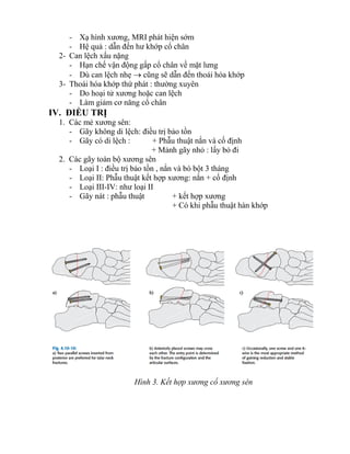 - Xạ hình xƣơng, MRI phát hiện sớm
- Hệ quả : dẫn đến hƣ khớp cổ chân
2- Can lệch xấu nặng
- Hạn chế vận động gấp cổ chân về mặt lƣng
- Dù can lệch nhẹ  cũng sẽ dẫn đến thoái hóa khớp
3- Thoái hóa khớp thứ phát : thƣờng xuyên
- Do hoại tử xƣơng hoặc can lệch
- Làm giảm cơ năng cổ chân
IV. ĐIỀU TRỊ
1. Các mẻ xƣơng sên:
- Gãy không di lệch: điều trị bảo tồn
- Gãy có di lệch : + Phẫu thuật nắn và cố định
+ Mảnh gãy nhỏ : lấy bỏ đi
2. Các gãy toàn bộ xƣơng sên
- Loại I : điều trị bảo tồn , nắn và bó bột 3 tháng
- Loại II: Phẫu thuật kết hợp xƣơng: nắn + cố định
- Loại III-IV: nhƣ loại II
- Gãy nát : phẫu thuật + kết hợp xƣơng
+ Có khi phẫu thuật hàn khớp
Hình 3. Kết hợp xương cổ xương sên
 