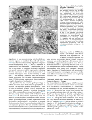 degradation of key rate-determining mitochondrial pro-
teins in response to metabolic ﬂux and cell stress,16–
18,58,63
(3) chaperone-like assembly of protein complexes
within the respiratory chain,21,64
and (4) regulation of
mitochondrial gene expression.46
Homozygous loss of
Lon in mice results in embryonic death associated with
poor growth and reduced mtDNA copy number, indicating
the vital importance of this protein in mammals.15
In
contrast, heterozygous mice mature similarly to wild-
type.15
These ﬁndings, combined with our enzymatic
studies, support the idea that allele combinations giving
rise to CODAS syndrome must result in alteration and not
complete abrogation of Lon function.
We speculate that the complex pathophysiology of
CODAS syndrome most likely reﬂects dysregulation of
multiple Lon-dependent proteins and pathways. There
are clinical similarities between CODAS syndrome and
other mitochondrial disorders, including hypotonia,
motor delay, ptosis, and sensorineural hearing loss.48,65–67
However, many classic clinical and biochemical hall-
marks48,67,68
of mitochondrial dysfunction were not
observed in CODAS children, and several CODAS manifes-
tations, including postnatal cataracts, skeletal and dental
abnormalities, and conductive hearing loss, are atypical
of mitochondrial disease. Such complications might reﬂect
Lon-dependent processes that are currently unknown.
Moreover, tissue-speciﬁc defects could arise because of dif-
ferential histological dependence on Lon as a protease, a
Figure 6. Abnormal Mitochondrial Ultra-
structure in CODAS Cells
(A–D) Transmission electron micrographs
were generated from cell lines of (A and
C) two CODAS-syndrome-affected chil-
dren homozygous for p.Arg721Gly
(Gly721
/Gly721
) and (B and D, respectively)
their heterozygous unaffected mothers
(Arg721
/Gly721
). (A and C) In CODAS cells,
43% of mitochondria (n ¼ 59 cells, p 
0.001) display abnormal morphology,
including swollen intracristal space and/or
vesiculated cristae and electron-dense ag-
gregations (white arrows). The mitochon-
drion below the asterisk in (A0
) appears to
be in transition toward the vesiculated
state when it is compared to the normal
mitochondrion to the left of the asterisk.
(B and D) The mothers’ cells display
normal mitochondrial morphology (e.g.,
arrowheads); 14% show swelling of the
intracristal space (n ¼ 63 cells, p  0.001)
(N ¼ nucleus). Scale bars represent 1 mm
in (A–D) and 0.3 mm in magniﬁed regions
(A0
–D0
). The fathers’ cells show normal
mitochondrial morphology, and only
5.2% show cristal-space swelling (n ¼ 48)
(Figure S6).
chaperone, and/or a DNA-binding
protein. For example, some tissues
might be more dependent on Lon
to degrade oxidatively damaged pro-
teins, whereas others might depend critically on as-yet-
unknown Lon-mediated pathways. The reduced SRC of
CODAS LCLs suggests limited capacity to boost ATP pro-
duction in response to high energy demands, such as oc-
curs during increased cellular stress and work load. Further
investigations using tissues with metabolic demands
higher than those of lymphoblastoid cells are needed if
we are to delineate the physiological relevance of mecha-
nistic defects in mitochondrial function and morphology
associated with CODAS syndrome.
Pathogenic Amino Acid Changes in CODAS Syndrome
Cluster in the AAAþ Domain
Our structural analysis of homozygous CODAS variants is
consistent with observed alterations of their enzyme activ-
ity in vitro. Proline676
is located within an a helix near the
ATP-binding pocket and generates a kink in this a helix69
(Figure 3C). Removal of the kink at Pro676 might alter
key hydrophobic interactions with four other residues—
Ala670 (on the same helix as Pro676), Leu667, Leu696,
and Val716—that likely help to shape the active site
(Figure 3C). The p.Pro676Ser substitution could disrupt
this kink, changing active site geometry or ﬂexibility of
the AAAþ
module (Figure 3C) and decreasing the protein’s
capacity for ATP binding and hydrolysis. Accordingly, we
found reduced ATP-dependent peptidase (Figure 4A) and
substrate-speciﬁc protease (Figure 4B) activities of the
p.Pro676Ser variant.
The American Journal of Human Genetics 96, 121–135, January 8, 2015 131
 