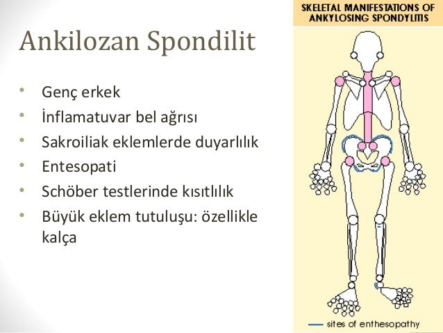 seronegatif spondiloartropatiler ankilozan spondilit