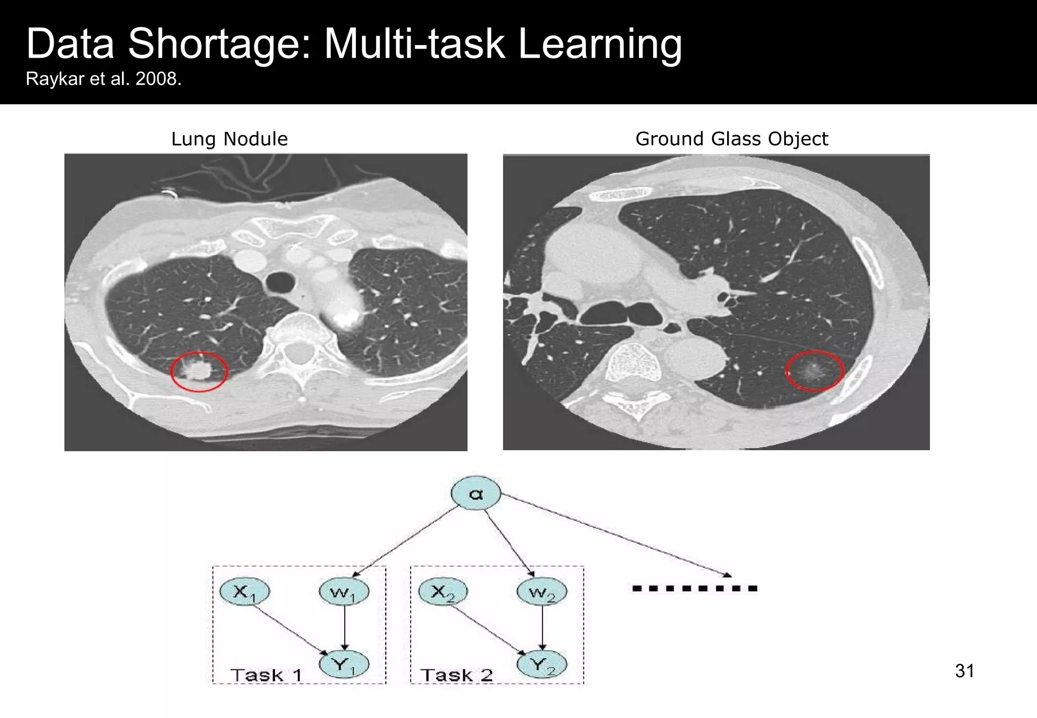Data Shortage: Multi-task Learning
Raykar et al. 2008.
Lung Nodule Ground Glass Object
31
 