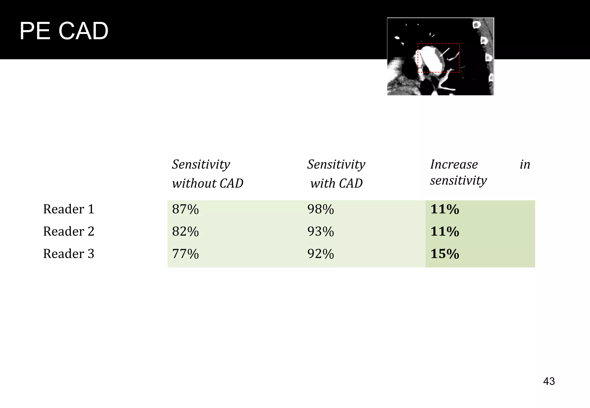 PE CAD
Das et al. 2008 conducted a study with 43 patients to asses the
sensitivity of detection of pulmonary embolism.
.
Sensitivity
without CAD
Sensitivity
with CAD
Increase in
sensitivity
Reader 1 87% 98% 11%
Reader 2 82% 93% 11%
Reader 3 77% 92% 15%
43
 