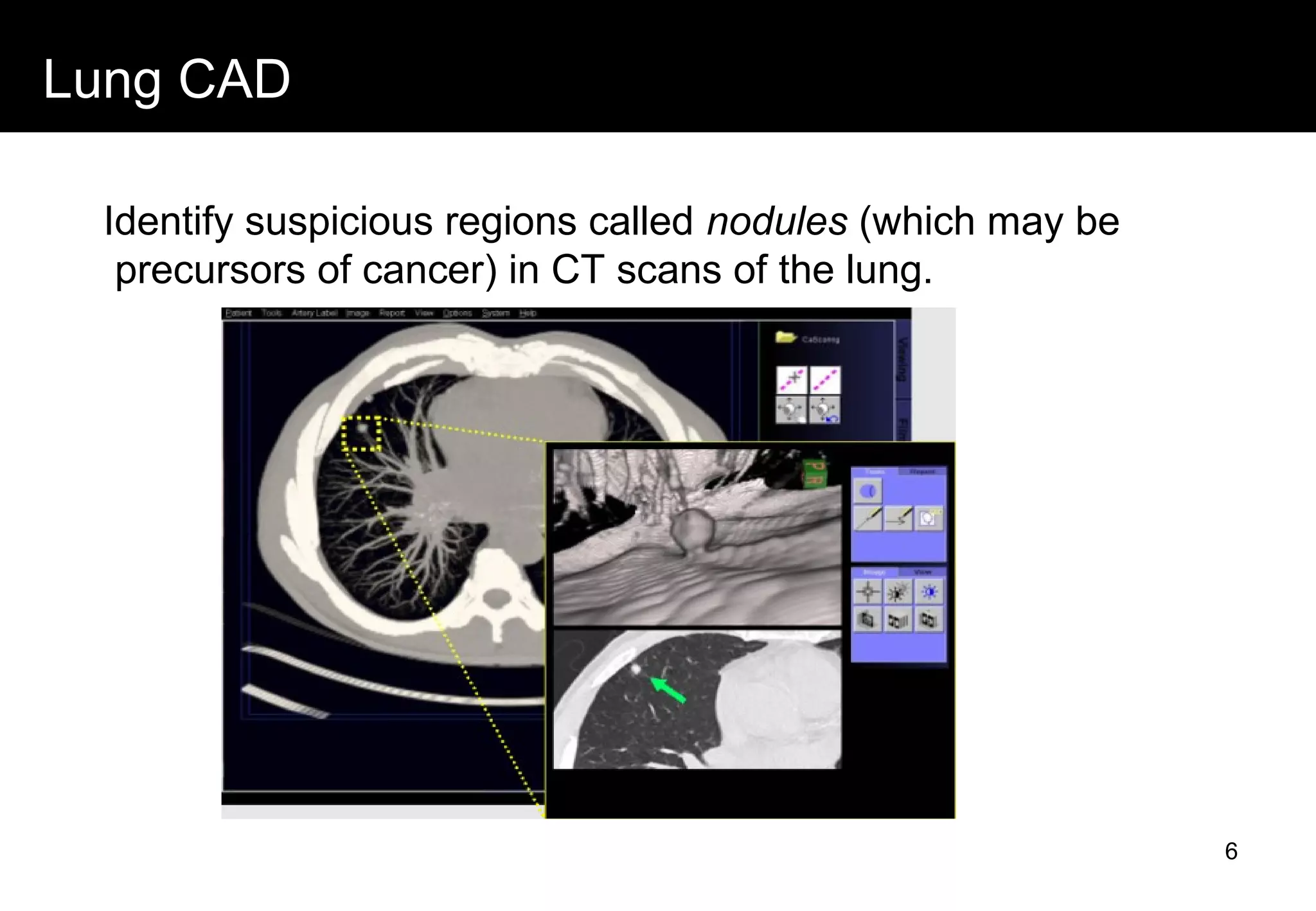 Lung CAD
Identify suspicious regions called nodules (which may be
precursors of cancer) in CT scans of the lung.
6
 