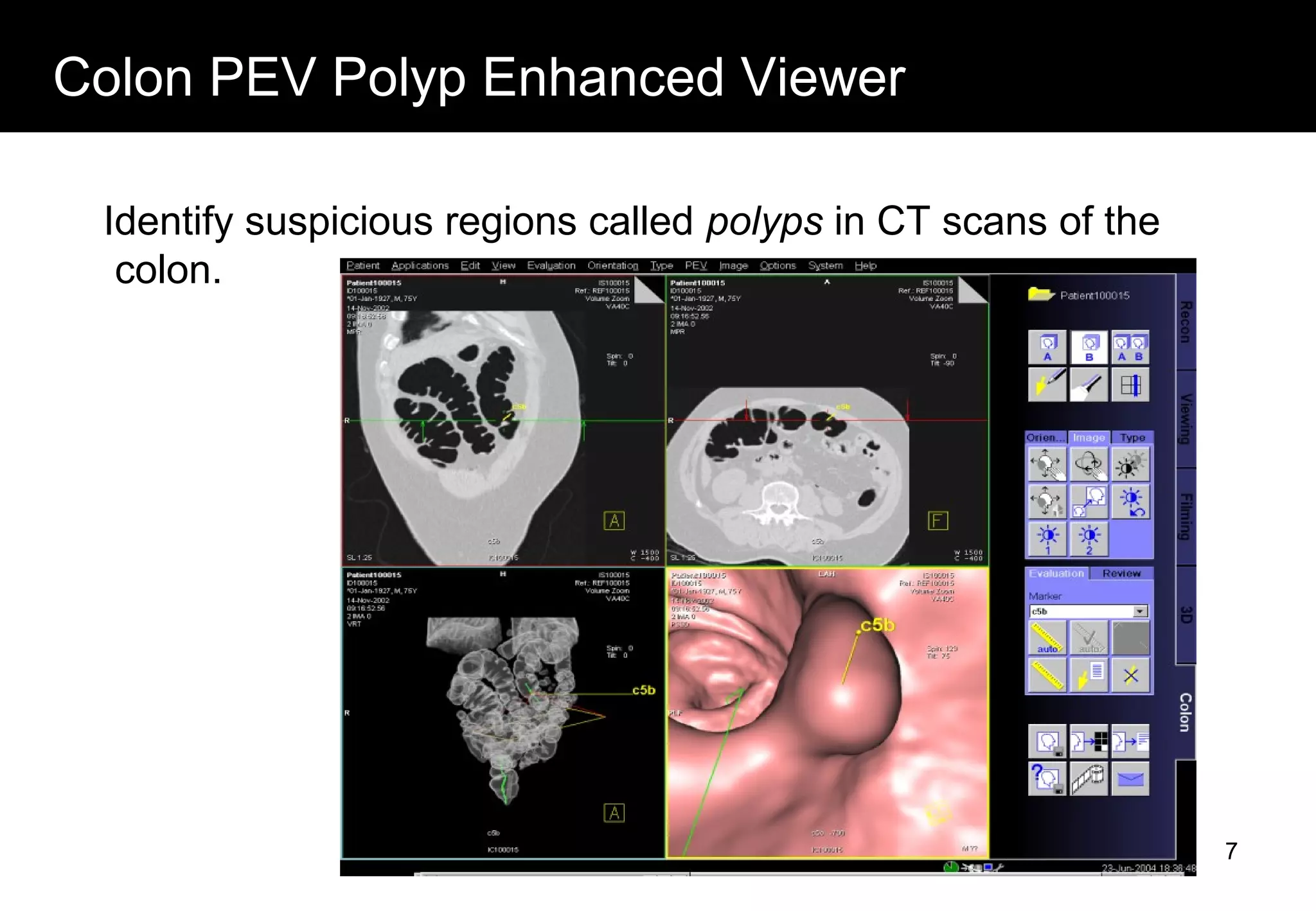 Colon PEV Polyp Enhanced Viewer
Identify suspicious regions called polyps in CT scans of the
colon.
7
 
