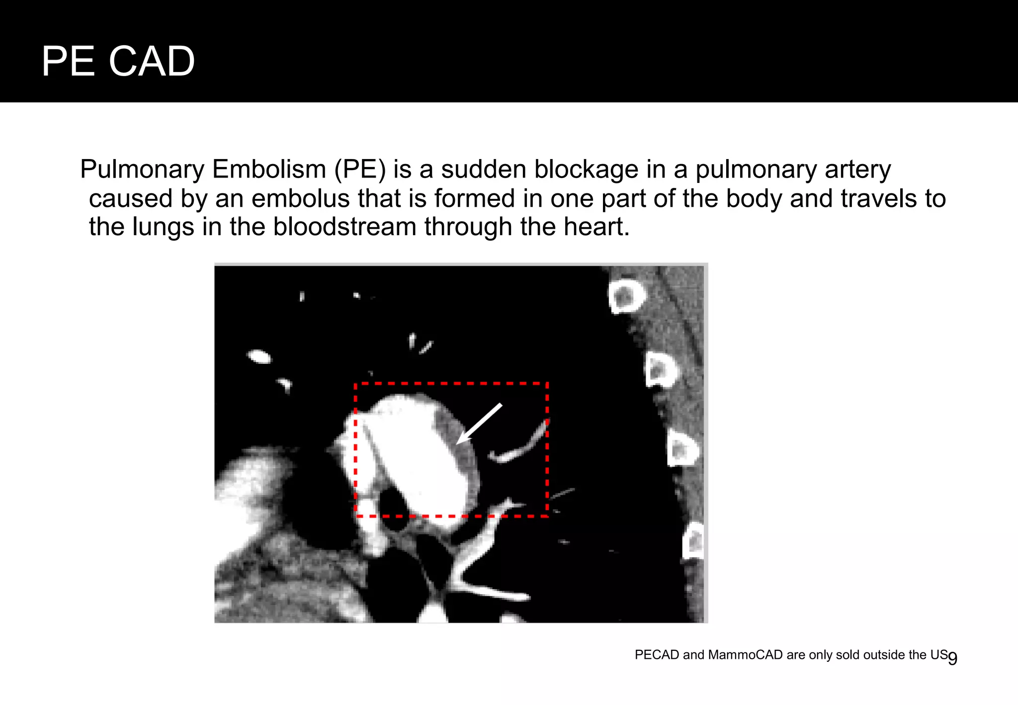 PE CAD
Pulmonary Embolism (PE) is a sudden blockage in a pulmonary artery
caused by an embolus that is formed in one part of the body and travels to
the lungs in the bloodstream through the heart.
PECAD and MammoCAD are only sold outside the US.9
 
