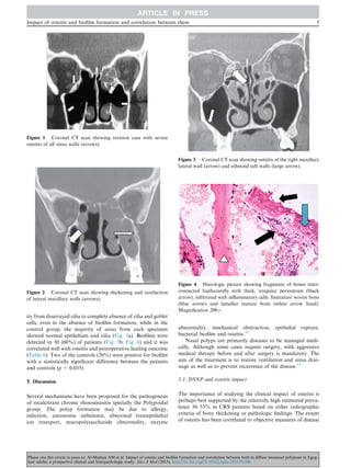 ity from disarrayed cilia to complete absence of cilia and goblet
cells, even in the absence of bioﬁlm formation, while in the
control group, the majority of areas from each specimen
showed normal epithelium and cilia (Fig. 5a). Bioﬁlms were
detected in 30 (60%) of patients (Fig. 5b, Fig. 6) and it was
correlated well with osteitis and postoperative healing outcome
(Table 6). Two of the controls (20%) were positive for bioﬁlm
with a statistically signiﬁcant difference between the patients
and controls (p = 0.035).
5. Discussion
Several mechanisms have been proposed for the pathogenesis
of recalcitrant chronic rhinosinusitis specially the Polypoidal
group. The polyp formation may be due to allergy,
infection, autonomic imbalance, abnormal transepithelial
ion transport, mucopolysaccharide abnormality, enzyme
abnormality, mechanical obstruction, epithelial rupture,
bacterial bioﬁlm and osteitis.16
Nasal polyps are primarily diseases to be managed medi-
cally. Although some cases require surgery, with aggressive
medical therapy before and after surgery is mandatory. The
aim of the treatment is to restore ventilation and sinus drai-
nage as well as to prevent recurrence of the disease.12
5.1. DSNP and osteitis impact
The importance of studying the clinical impact of osteitis is
perhaps best supported by the relatively high estimated preva-
lence 36–53% in CRS patients based on either radiographic
criteria of bony thickening or pathologic ﬁndings. The extent
of osteitis has been correlated to objective measures of disease
Figure 3 Coronal CT scan showing osteitis of the right maxillary
lateral wall (arrow) and ethmoid cell walls (large arrow).
Figure 2 Coronal CT scan showing thickening and rarefaction
of lateral maxillary walls (arrows).
Figure 1 Coronal CT scan showing revision case with severe
osteitis of all sinus walls (arrows).
Figure 4 Histologic picture showing fragments of bones inter-
connected haphazardly with thick, irregular periosteum (black
arrow), inﬁltrated with inﬂammatory cells. Immature woven bone
(blue arrow) and lamellar mature bone (white arrow head).
Magniﬁcation 200Â.
Impact of osteitis and bioﬁlm formation and correlation between them 5
Please cite this article in press as: Al-Madani AM et al. Impact of osteitis and bioﬁlm formation and correlation between both in diﬀuse sinonasal polyposis in Egyp-
tian adults; a prospective clinical and histopathologic study, Alex J Med (2015), http://dx.doi.org/10.1016/j.ajme.2015.09.006
 