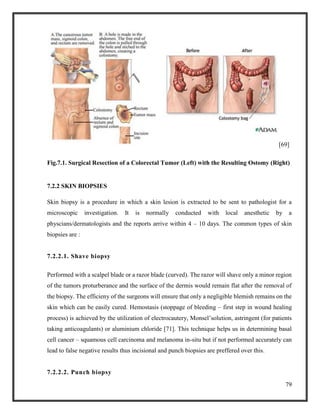 79
[69]
Fig.7.1. Surgical Resection of a Colorectal Tumor (Left) with the Resulting Ostomy (Right)
7.2.2 SKIN BIOPSIES
Skin biopsy is a procedure in which a skin lesion is extracted to be sent to pathologist for a
microscopic investigation. It is normally conducted with local anesthetic by a
physcians/dermatologists and the reports arrive within 4 – 10 days. The common types of skin
biopsies are :
7.2.2.1. Shave biopsy
Performed with a scalpel blade or a razor blade (curved). The razor will shave only a minor region
of the tumors proturberance and the surface of the dermis would remain flat after the removal of
the biopsy. The efficieny of the surgeons will ensure that only a negligible blemish remains on the
skin which can be easily cured. Hemostasis (stoppage of bleeding – first step in wound healing
process) is achieved by the utilization of electrocautery, Monsel’solution, astringent (for patients
taking anticoagulants) or aluminium chloride [71]. This technique helps us in determining basal
cell cancer – squamous cell carcinoma and melanoma in-situ but if not performed accurately can
lead to false negative results thus incisional and punch biopsies are preffered over this.
7.2.2.2. Punch biopsy
 