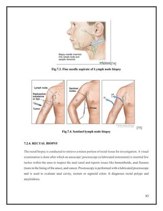 83
[74]
Fig.7.3. Fine needle aspirate of Lymph node biopsy
[75]
Fig.7.4. Sentinel lymph node biopsy
7.2.4. RECTAL BIOPSY
The rectal biopsy is conducted to retrieve a minor portion of rectal tissue for investigation. A visual
examination is done after which an anoscope/ proctoscope (a lubricated instrument) is inserted few
inches within the anus to inspect the anal canal and reports issues like hemorrhoids, anal fissures
(tears in the lining of the anus), and cancer. Proctoscopy is performed with a lubricated proctoscope
and is used to evaluate anal cavity, rectum or sigmoid colon. It diagnoses rectal polyps and
amyloidosis.
 