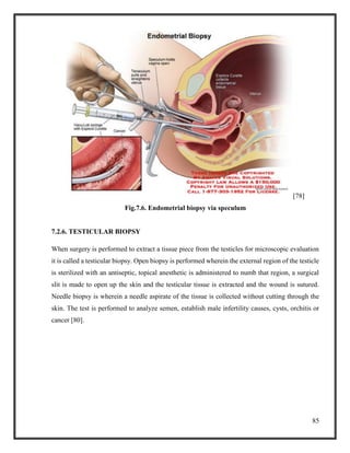 85
[78]
Fig.7.6. Endometrial biopsy via speculum
7.2.6. TESTICULAR BIOPSY
When surgery is performed to extract a tissue piece from the testicles for microscopic evaluation
it is called a testicular biopsy. Open biopsy is performed wherein the external region of the testicle
is sterilized with an antiseptic, topical anesthetic is administered to numb that region, a surgical
slit is made to open up the skin and the testicular tissue is extracted and the wound is sutured.
Needle biopsy is wherein a needle aspirate of the tissue is collected without cutting through the
skin. The test is performed to analyze semen, establish male infertility causes, cysts, orchitis or
cancer [80].
 