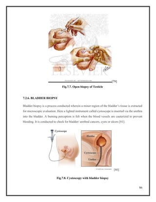 86
[79]
Fig.7.7. Open biopsy of Testicle
7.2.6. BLADDER BIOPSY
Bladder biopsy is a process conducted wherein a minor region of the bladder’s tissue is extracted
for microscopic evaluation. Here a lighted instrument called cystoscope is inserted via the urethra
into the bladder. A burning perception is felt when the blood vessels are cauterized to prevent
bleeding. It is conducted to check for bladder/ urethral cancers, cysts or ulcers [81].
[80]
Fig.7.8. Cystoscopy with bladder biopsy
 