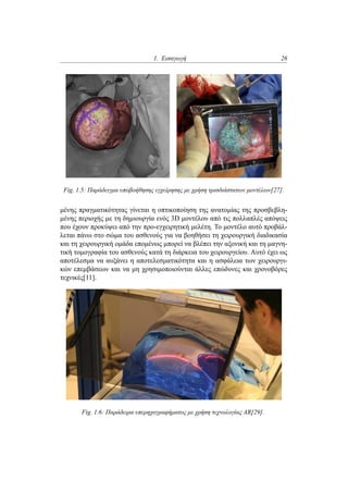 1. Εισαγωγή 26
Fig. 1.5: Παράδειγμα υποβοήθησης εγχείρησης με χρήση τρισδιάστατων μοντέλων[27].
μένης πραγματικότητας γίνεται η οπτικοποίηση της ανατομίας της προσβεβλη-
μένης περιοχής με τη δημιουργία ενός 3D μοντέλου από τις πολλαπλές απόψεις
που έχουν προκύψει από την προ-εγχειρητική μελέτη. Το μοντέλο αυτό προβάλ-
λεται πάνω στο σώμα του ασθενούς για να βοηθήσει τη χειρουργική διαδικασία
και τη χειρουργική ομάδα επομένως μπορεί να βλέπει την αξονική και τη μαγνη-
τική τομογραφία του ασθενούς κατά τη διάρκεια του χειρουργείου. Αυτό έχει ως
αποτέλεσμα να αυξάνει η αποτελεσματικότητα και η ασφάλεια των χειρουργι-
κών επεμβάσεων και να μη χρησιμοποιούνται άλλες επώδυνες και χρονοβόρες
τεχνικές[11].
Fig. 1.6: Παράδειρα υπερηχογραφήματος με χρήση τεχνολογίας AR[29].
 