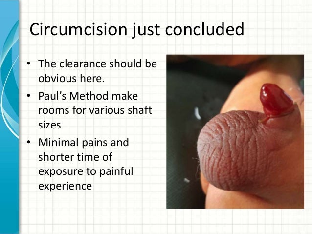 Baby Circumcision Ring Baby Circumcision Ring