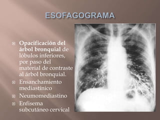  Opacificación del
árbol bronquial de
lóbulos inferiores,
por paso del
material de contraste
al árbol bronquial.
 Ensanchamiento
mediastínico
 Neumomediastino
 Enfisema
subcutáneo cervical
 