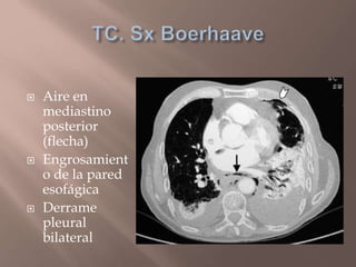  Aire en
mediastino
posterior
(flecha)
 Engrosamient
o de la pared
esofágica
 Derrame
pleural
bilateral
 