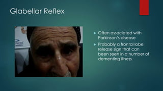 Glabellar Reflex
 Often associated with
Parkinson’s disease
 Probably a frontal lobe
release sign that can
been seen in a number of
dementing illness
 