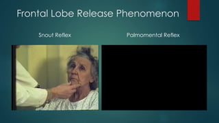 Frontal Lobe Release Phenomenon
Snout Reflex Palmomental Reflex
 