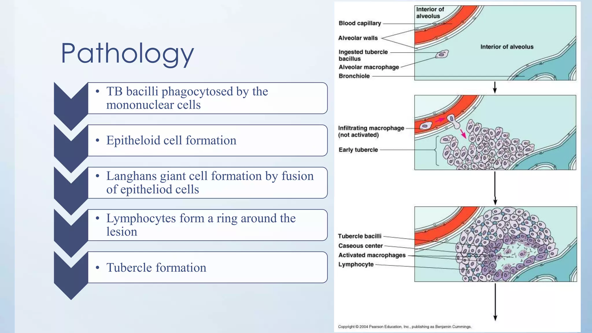 Pathology
• TB bacilli phagocytosed by the
mononuclear cells
• Epitheloid cell formation
• Langhans giant cell formation by fusion
of epitheliod cells
• Lymphocytes form a ring around the
lesion
• Tubercle formation
 