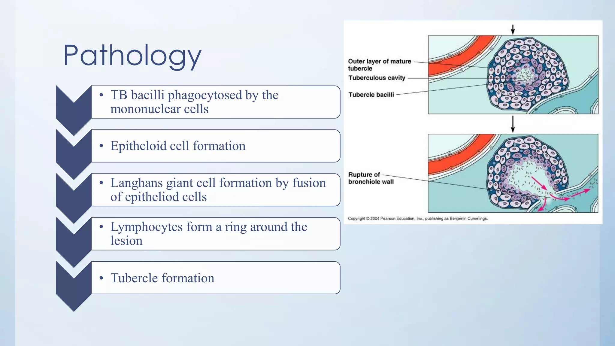 Pathology
• TB bacilli phagocytosed by the
mononuclear cells
• Epitheloid cell formation
• Langhans giant cell formation by fusion
of epitheliod cells
• Lymphocytes form a ring around the
lesion
• Tubercle formation
 
