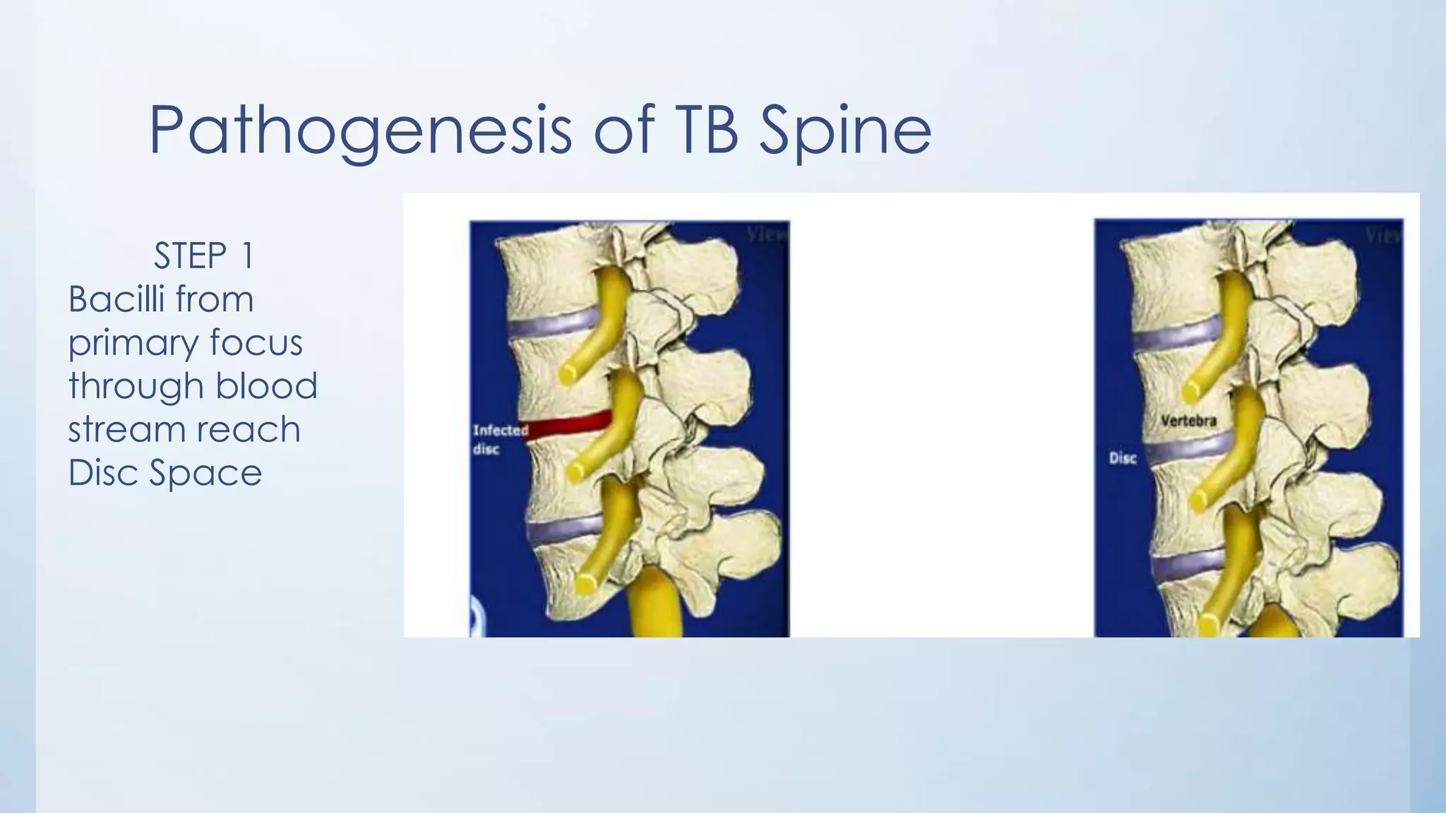 Pathogenesis of TB Spine
STEP 1
Bacilli from
primary focus
through blood
stream reach
Disc Space
 