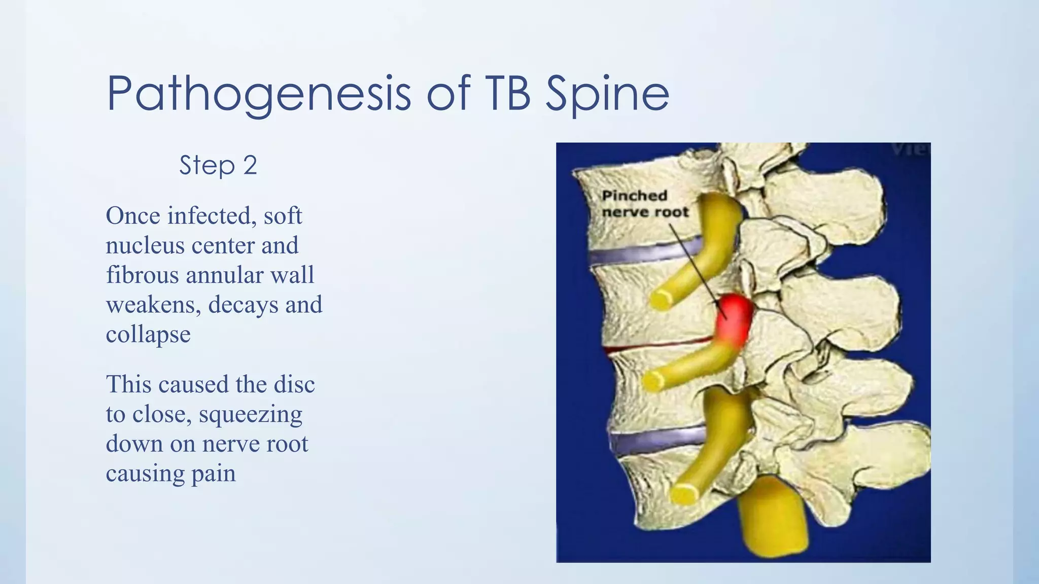 Pathogenesis of TB Spine
Step 2
Once infected, soft
nucleus center and
fibrous annular wall
weakens, decays and
collapse
This caused the disc
to close, squeezing
down on nerve root
causing pain
 