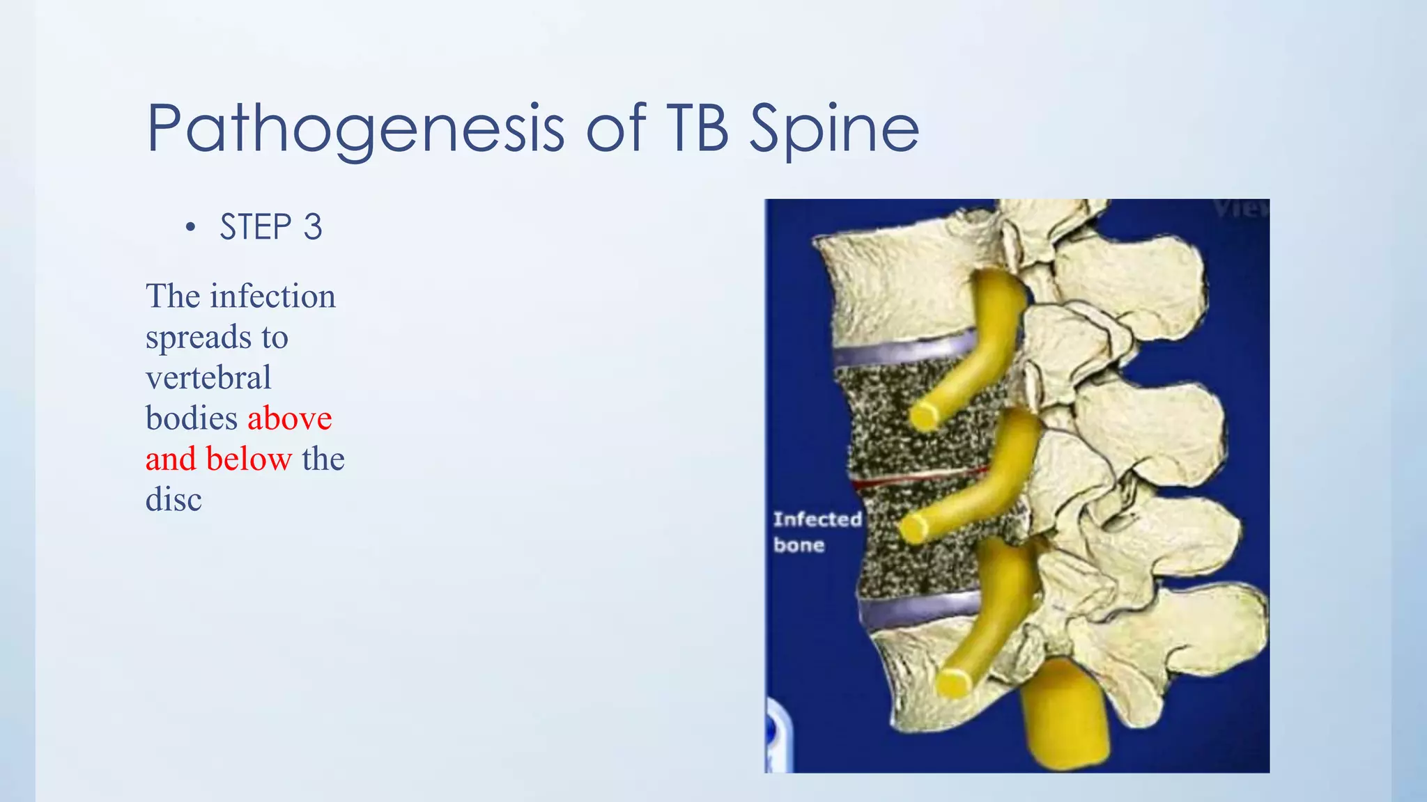 Pathogenesis of TB Spine
• STEP 3
The infection
spreads to
vertebral
bodies above
and below the
disc
 