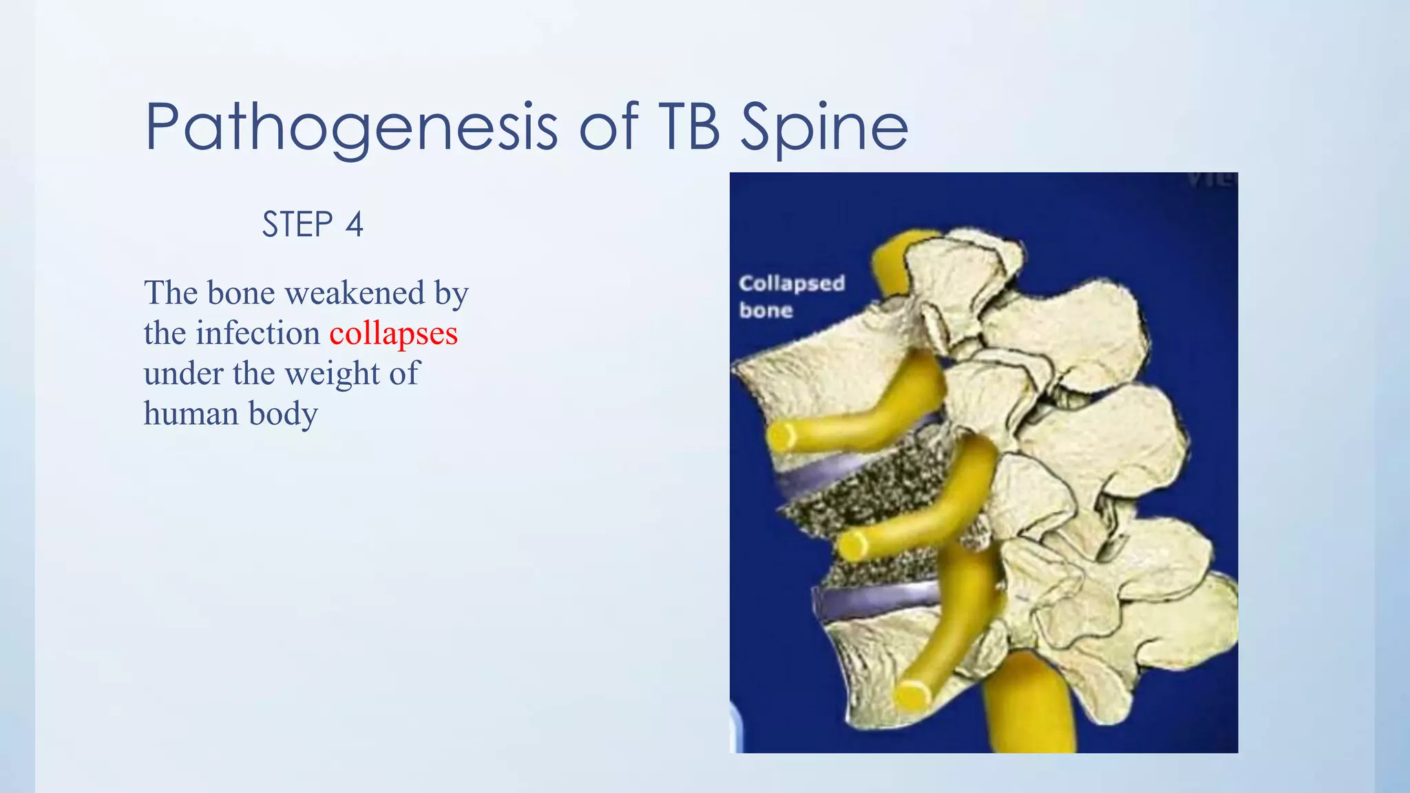Pathogenesis of TB Spine
STEP 4
The bone weakened by
the infection collapses
under the weight of
human body
 