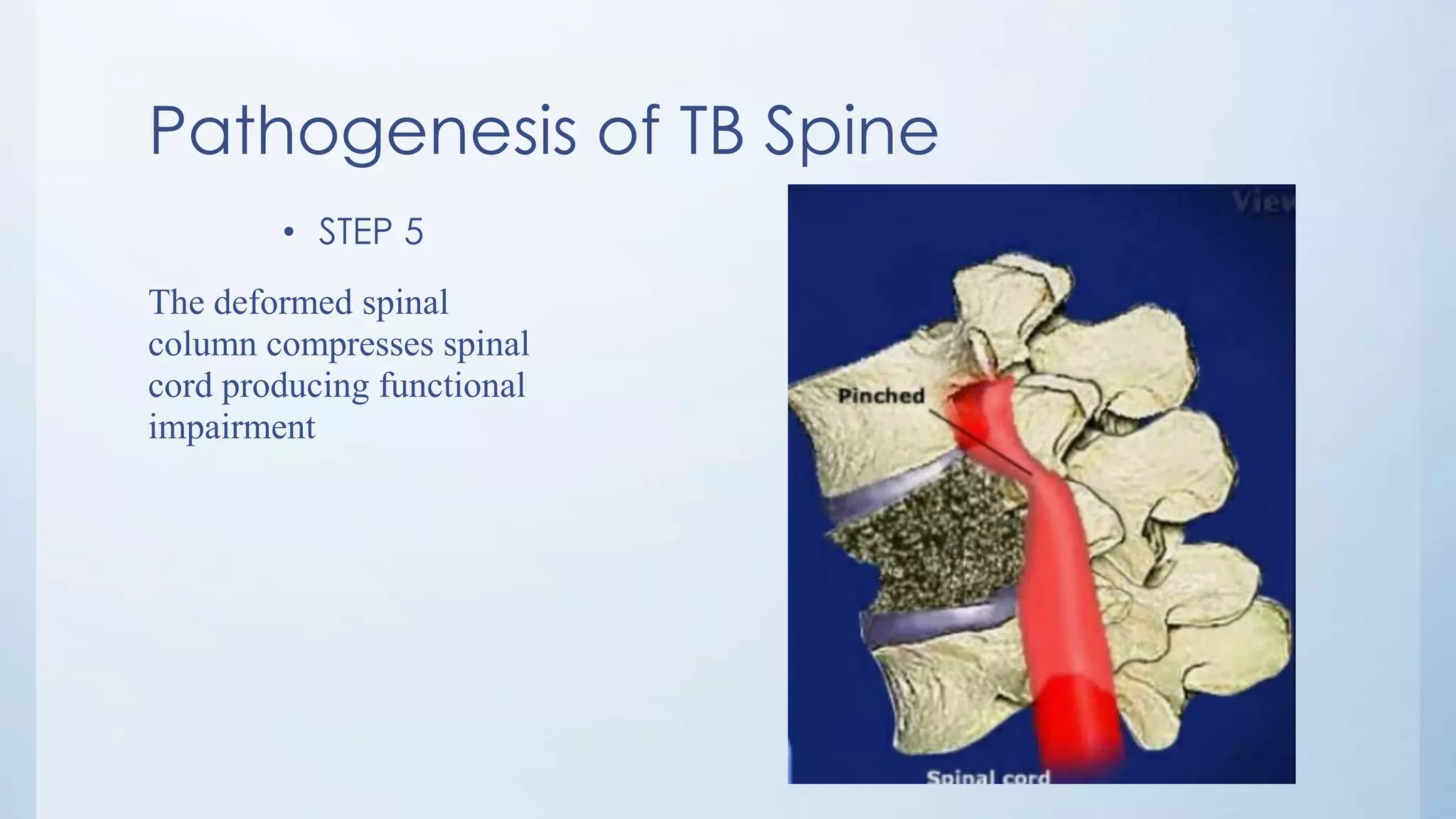 Pathogenesis of TB Spine
• STEP 5
The deformed spinal
column compresses spinal
cord producing functional
impairment
 