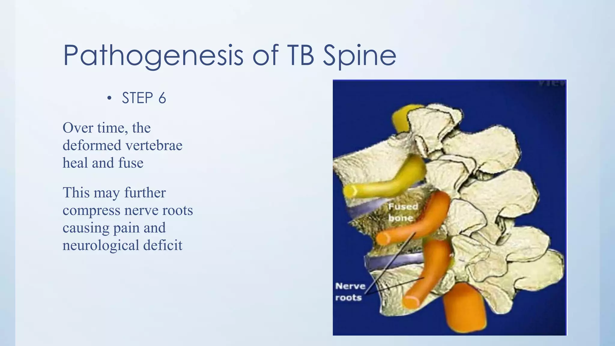Pathogenesis of TB Spine
• STEP 6
Over time, the
deformed vertebrae
heal and fuse
This may further
compress nerve roots
causing pain and
neurological deficit
 