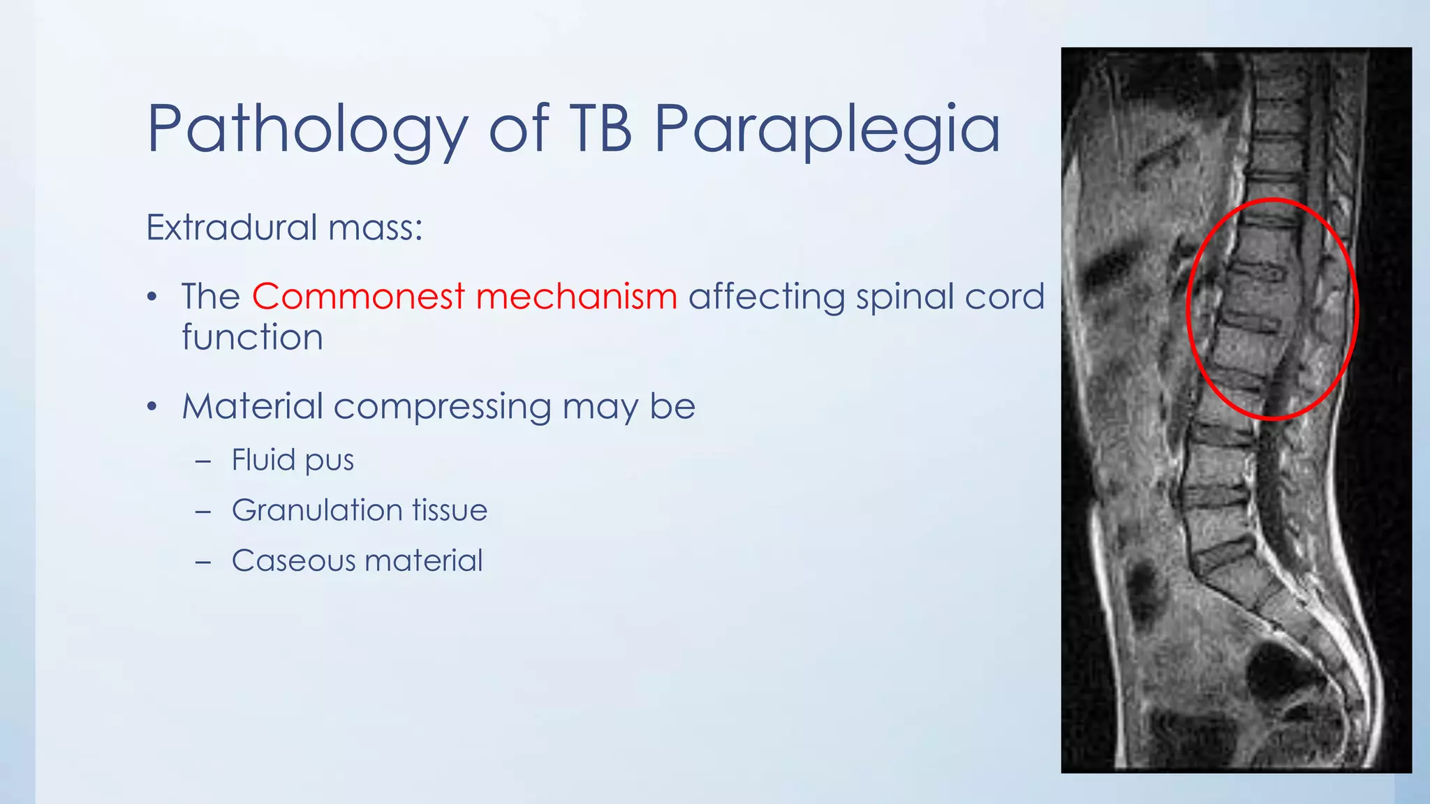 Pathology of TB Paraplegia
Extradural mass:
• The Commonest mechanism affecting spinal cord
function
• Material compressing may be
– Fluid pus
– Granulation tissue
– Caseous material
 