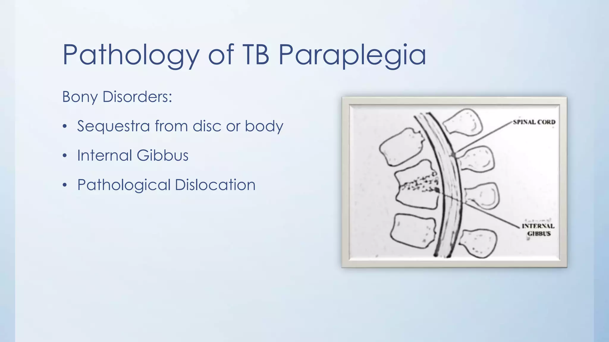 Pathology of TB Paraplegia
Bony Disorders:
• Sequestra from disc or body
• Internal Gibbus
• Pathological Dislocation
 