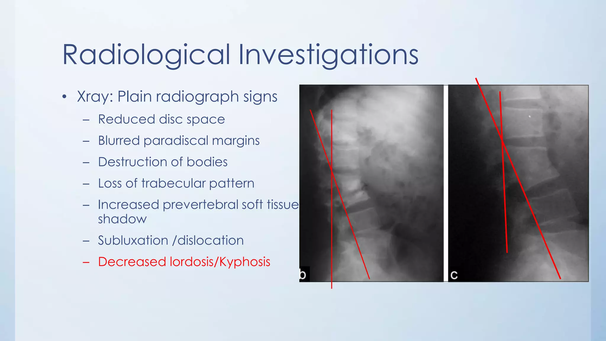 Radiological Investigations
• Xray: Plain radiograph signs
– Reduced disc space
– Blurred paradiscal margins
– Destruction of bodies
– Loss of trabecular pattern
– Increased prevertebral soft tissue
shadow
– Subluxation /dislocation
– Decreased lordosis/Kyphosis
 