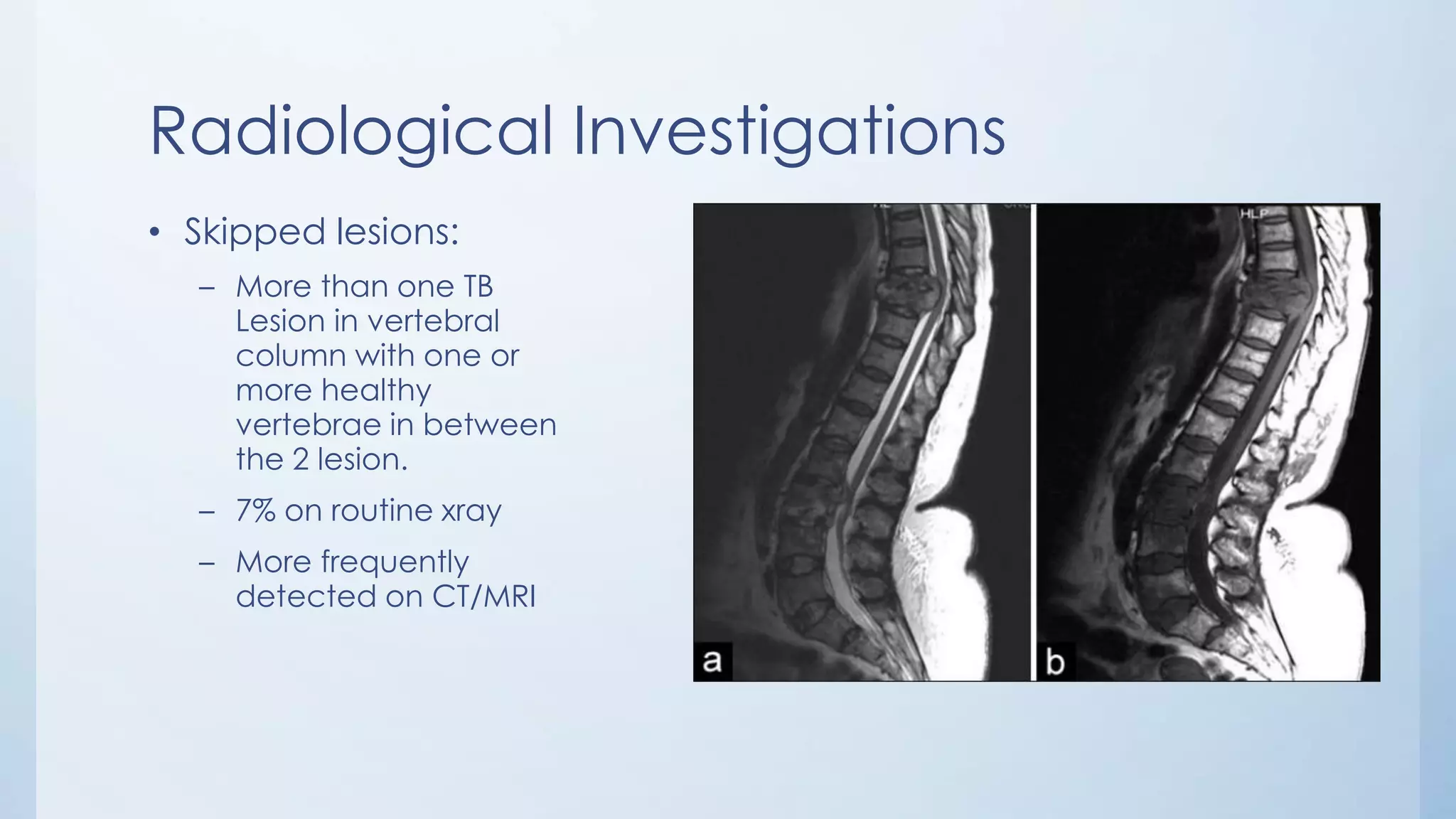 Radiological Investigations
• Skipped lesions:
– More than one TB
Lesion in vertebral
column with one or
more healthy
vertebrae in between
the 2 lesion.
– 7% on routine xray
– More frequently
detected on CT/MRI
 