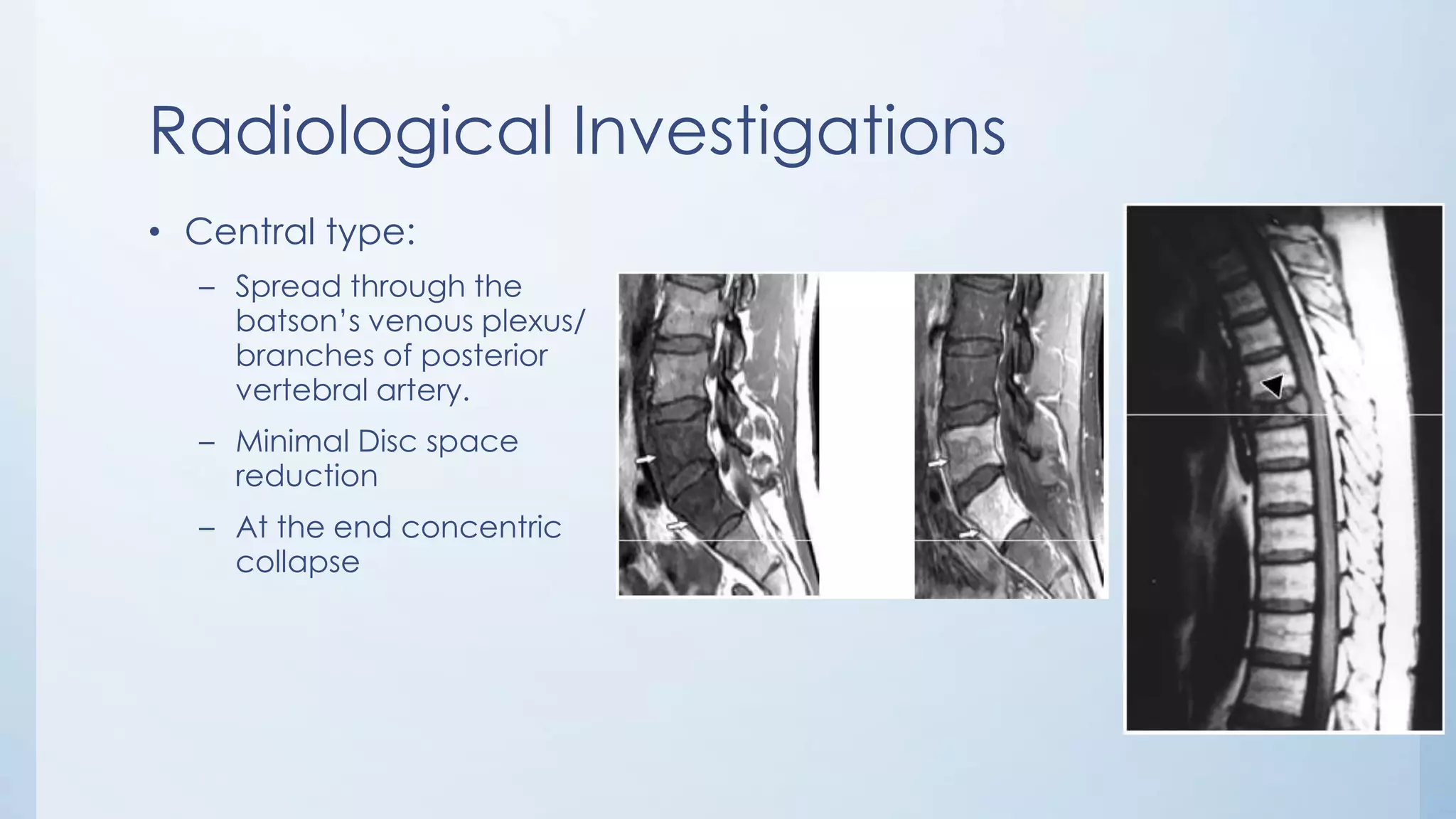 Radiological Investigations
• Central type:
– Spread through the
batson’s venous plexus/
branches of posterior
vertebral artery.
– Minimal Disc space
reduction
– At the end concentric
collapse
 