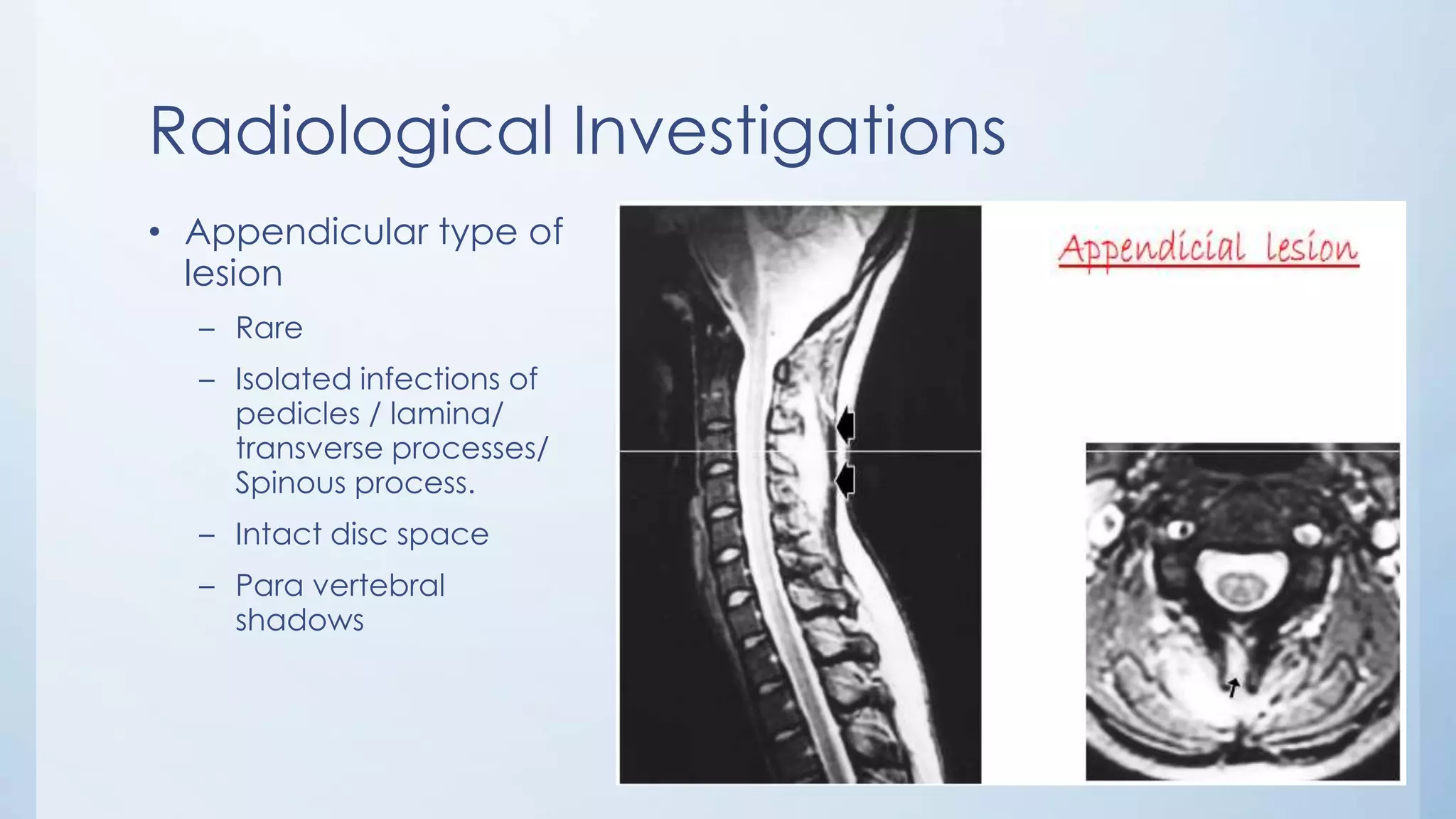 Radiological Investigations
• Appendicular type of
lesion
– Rare
– Isolated infections of
pedicles / lamina/
transverse processes/
Spinous process.
– Intact disc space
– Para vertebral
shadows
 