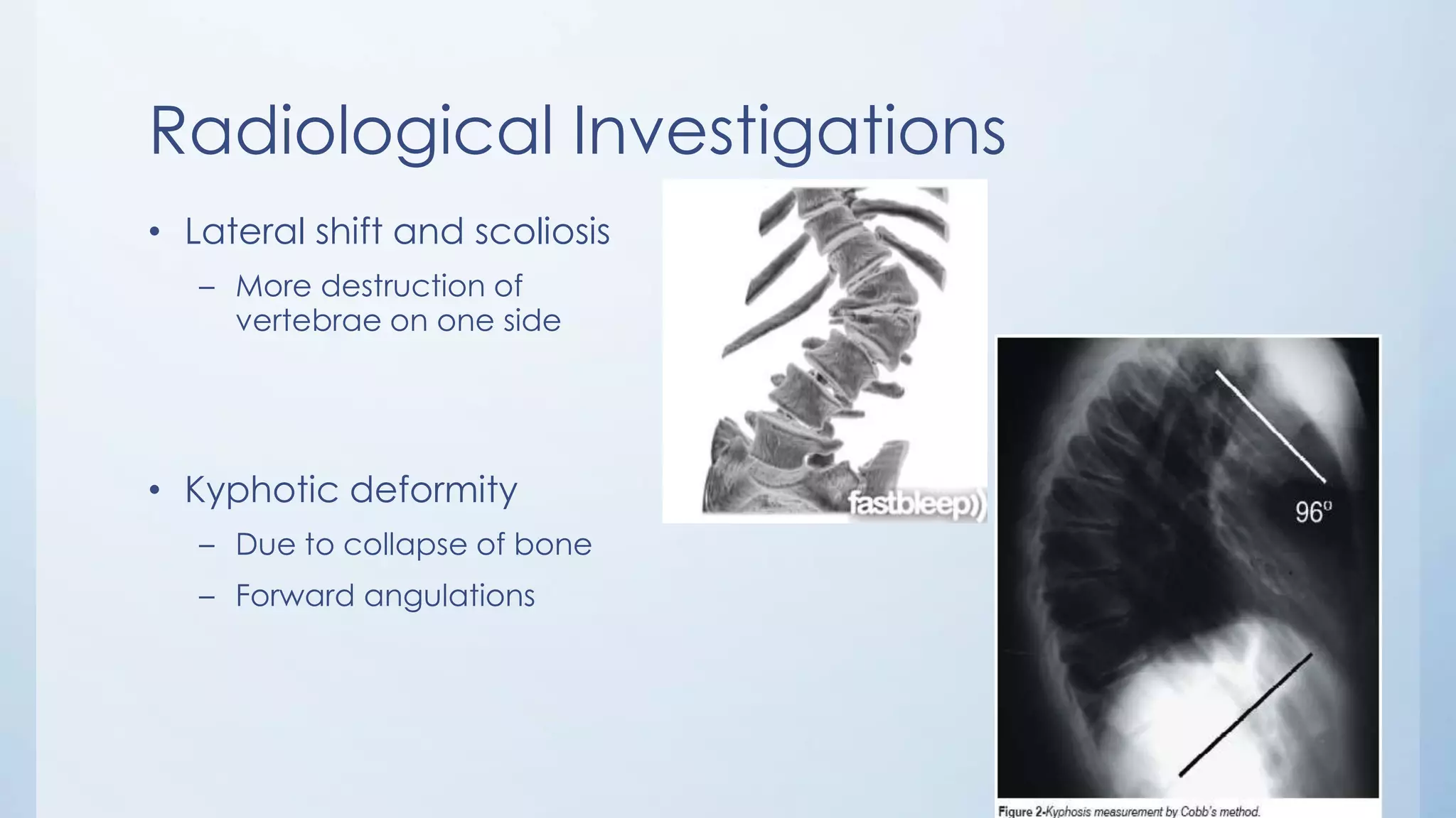 Radiological Investigations
• Lateral shift and scoliosis
– More destruction of
vertebrae on one side
• Kyphotic deformity
– Due to collapse of bone
– Forward angulations
 
