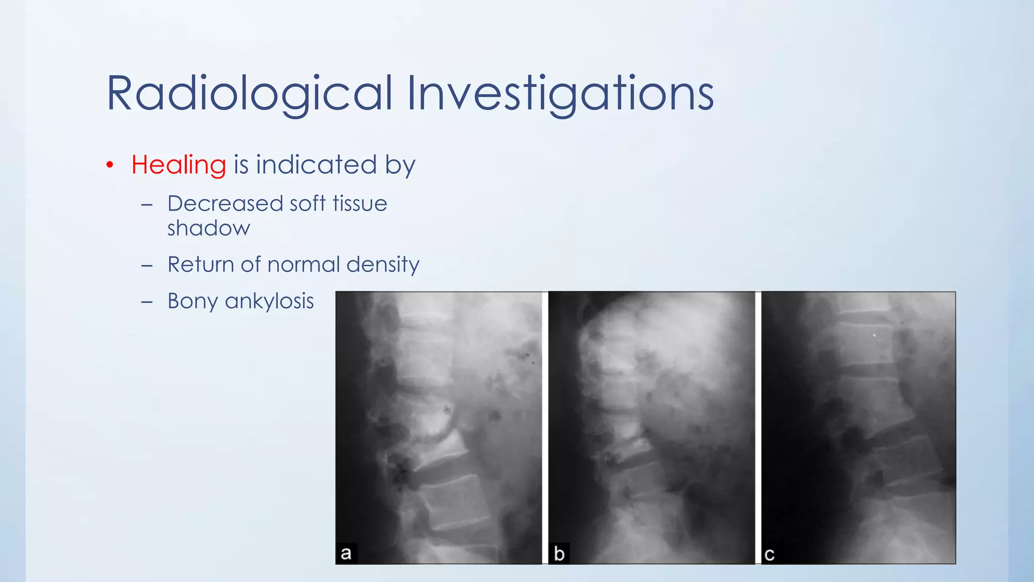 Radiological Investigations
• Healing is indicated by
– Decreased soft tissue
shadow
– Return of normal density
– Bony ankylosis
 