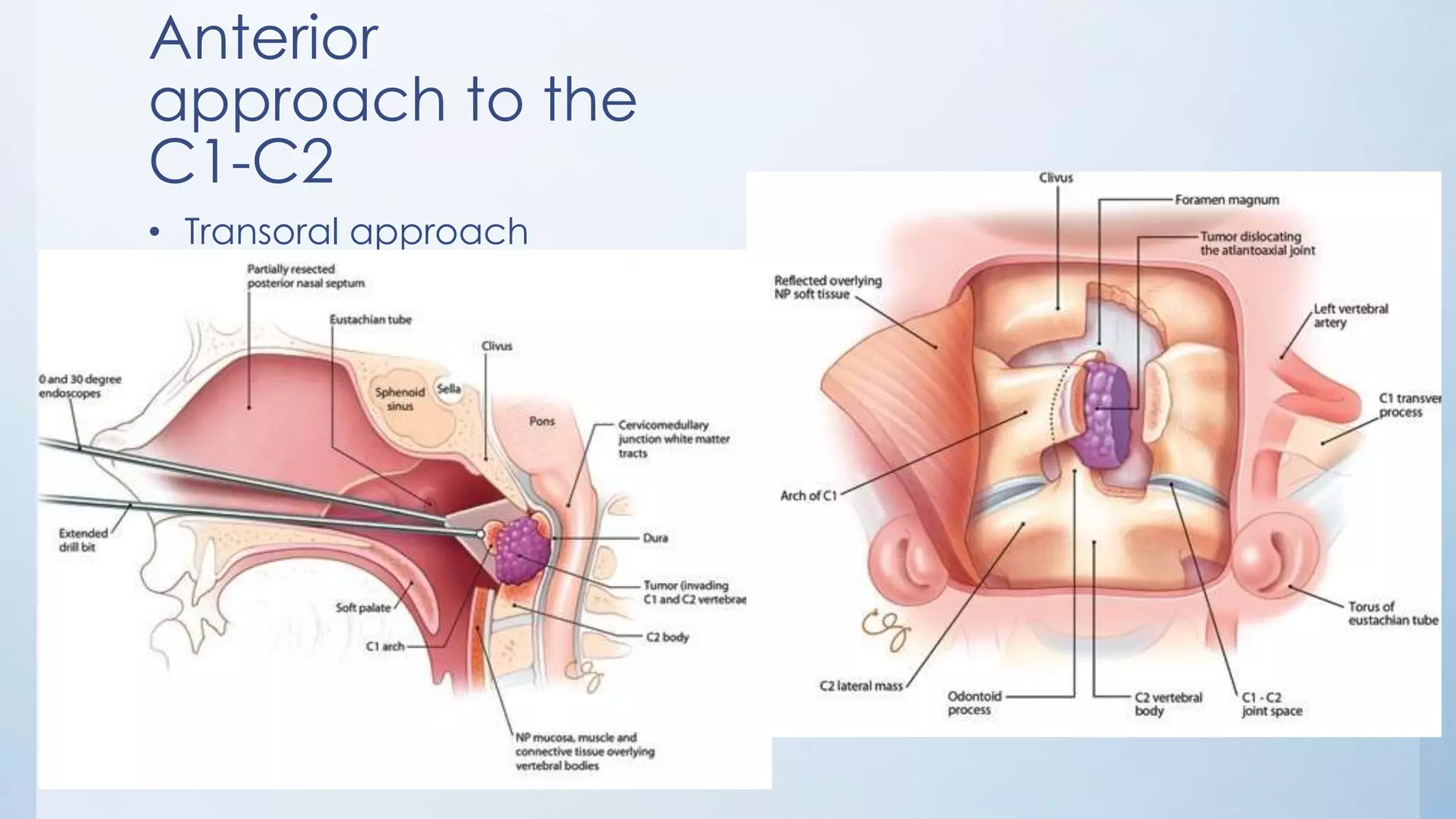 Anterior
approach to the
C1-C2
• Transoral approach
 