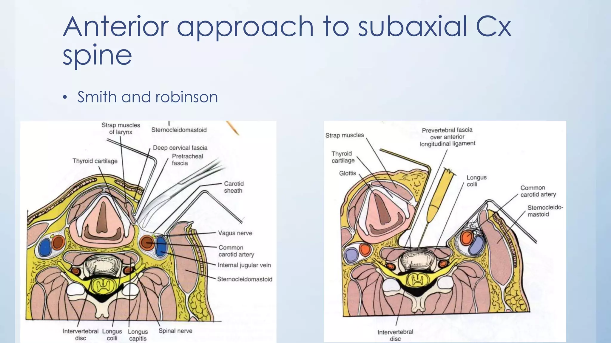 Anterior approach to subaxial Cx
spine
• Smith and robinson
 