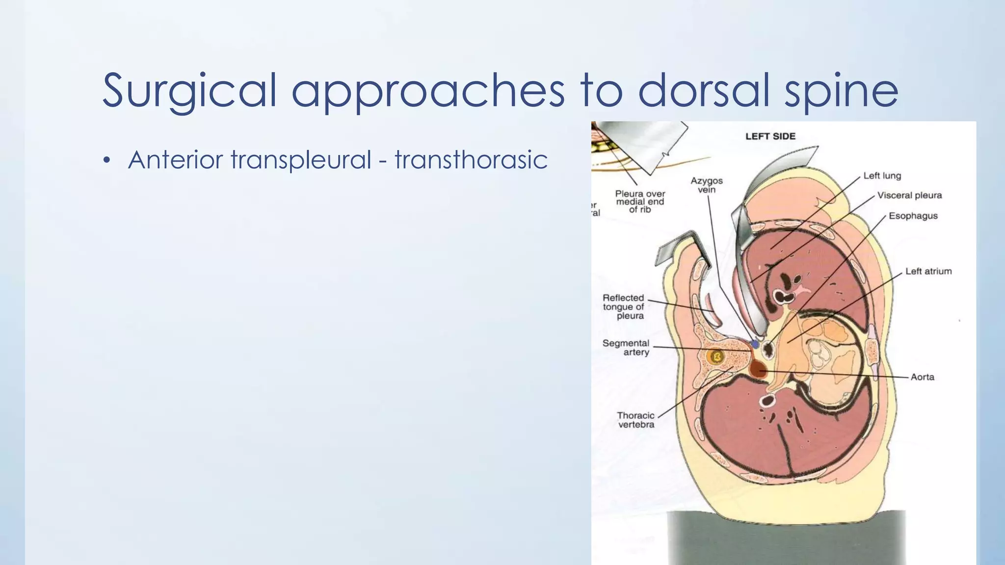 Surgical approaches to dorsal spine
• Anterior transpleural - transthorasic
 
