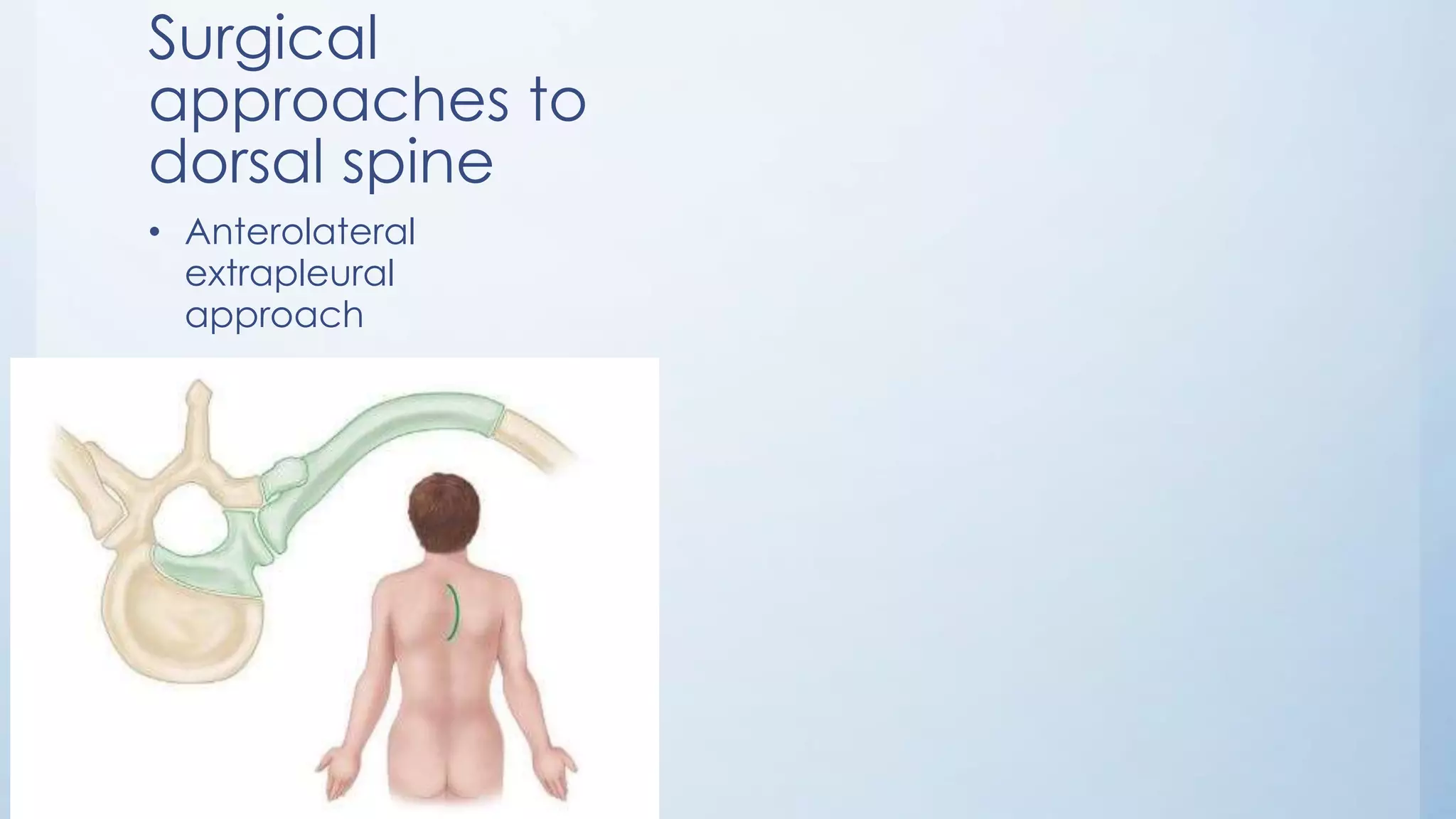 Surgical
approaches to
dorsal spine
• Anterolateral
extrapleural
approach
 