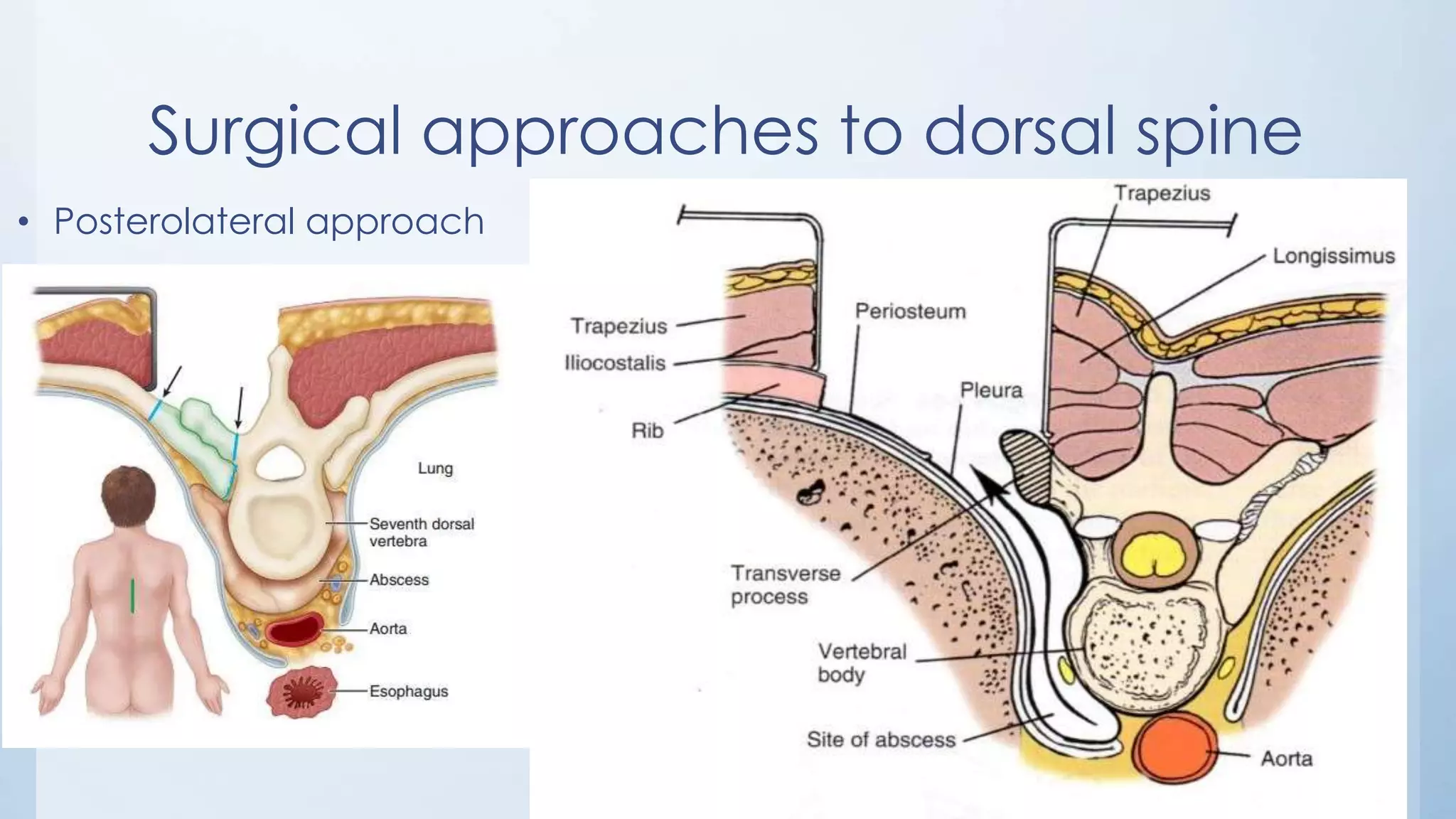 Surgical approaches to dorsal spine
• Posterolateral approach
 