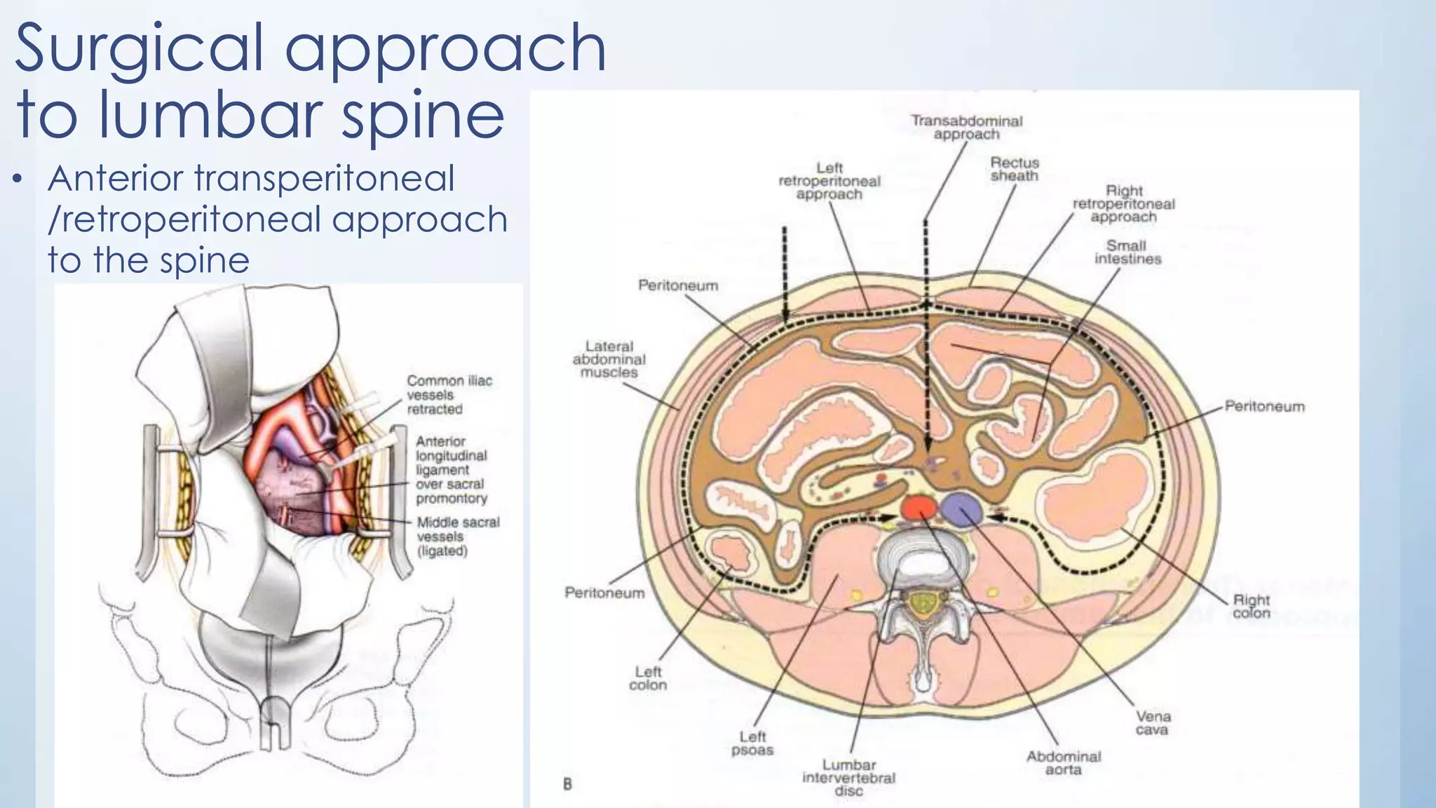 Surgical approach
to lumbar spine
• Anterior transperitoneal
/retroperitoneal approach
to the spine
 