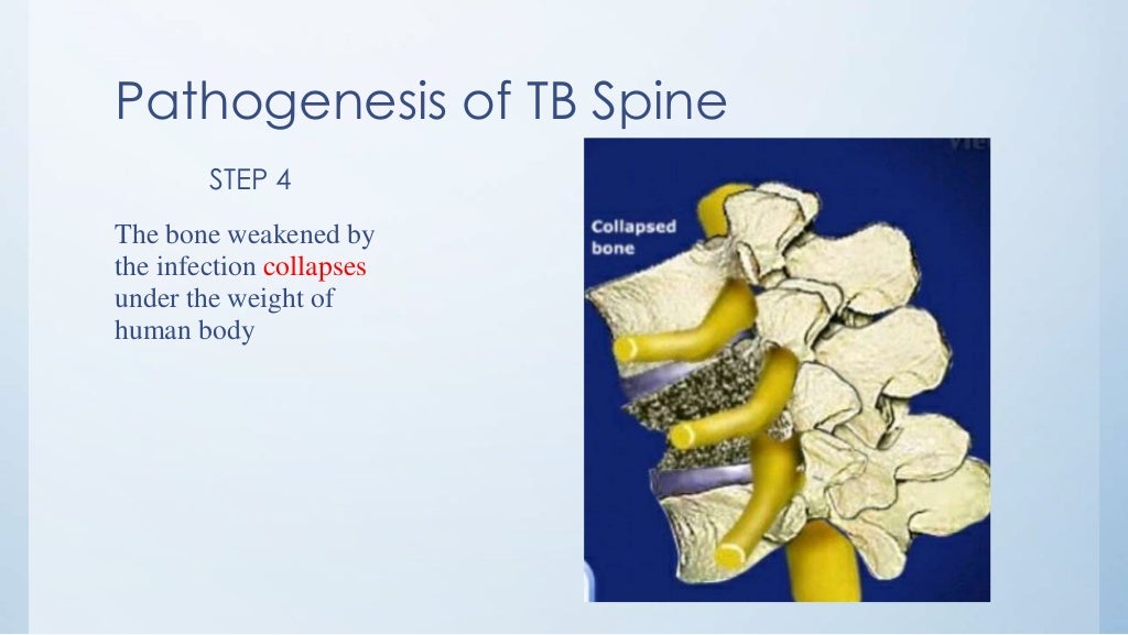 Tuberculosis of spine