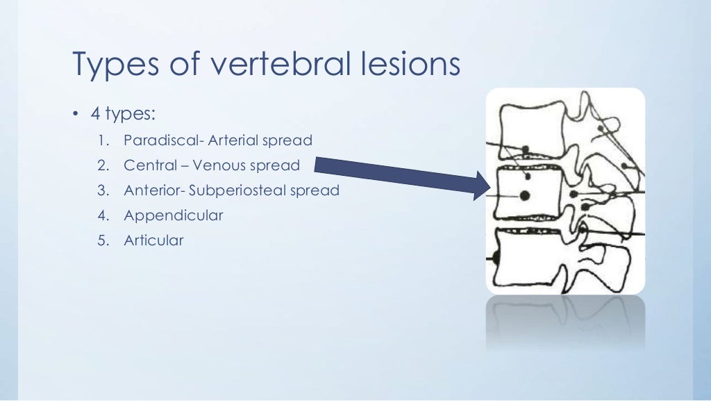 Tuberculosis of spine