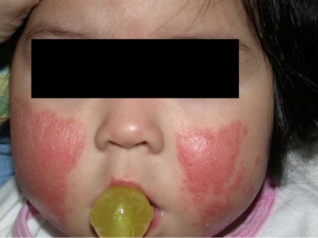La psoriasis de la foto de la fase inicial sobre el tórax