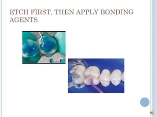 ETCH FIRST, THEN APPLY BONDING
AGENTS
 
