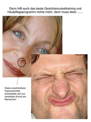 Dann hilft auch das beste Gesichtsmuskeltraining und Hautpflegeprogramm nichts mehr, dann muss eben …… Diese unscheinbare Hautunreinheit entwickelte sich zur entarteten Kunst am Menschen! 