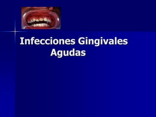 Infecciones Gingivales
      Agudas
 
